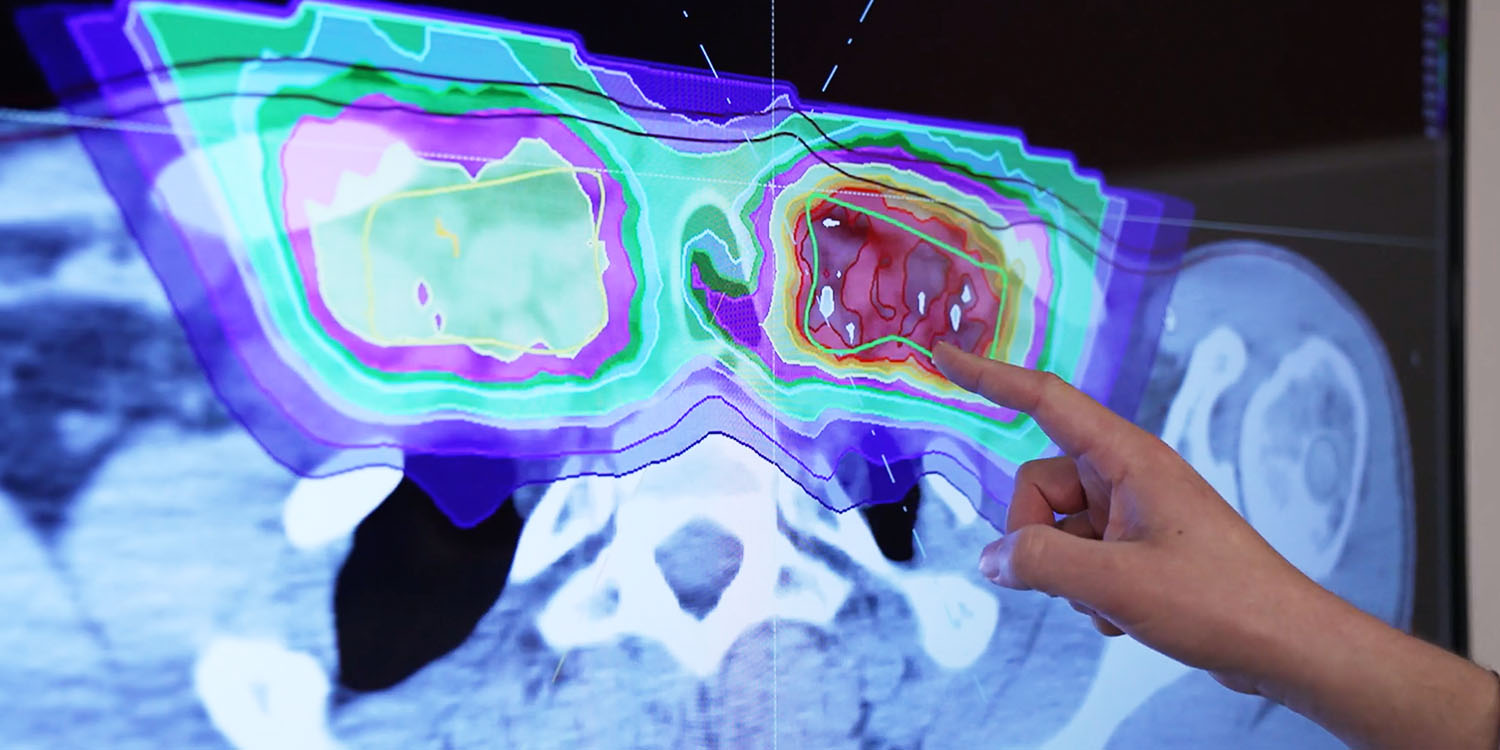 Medical dosimetry team looks at scan of tumor to determine proton therapy treatment plan