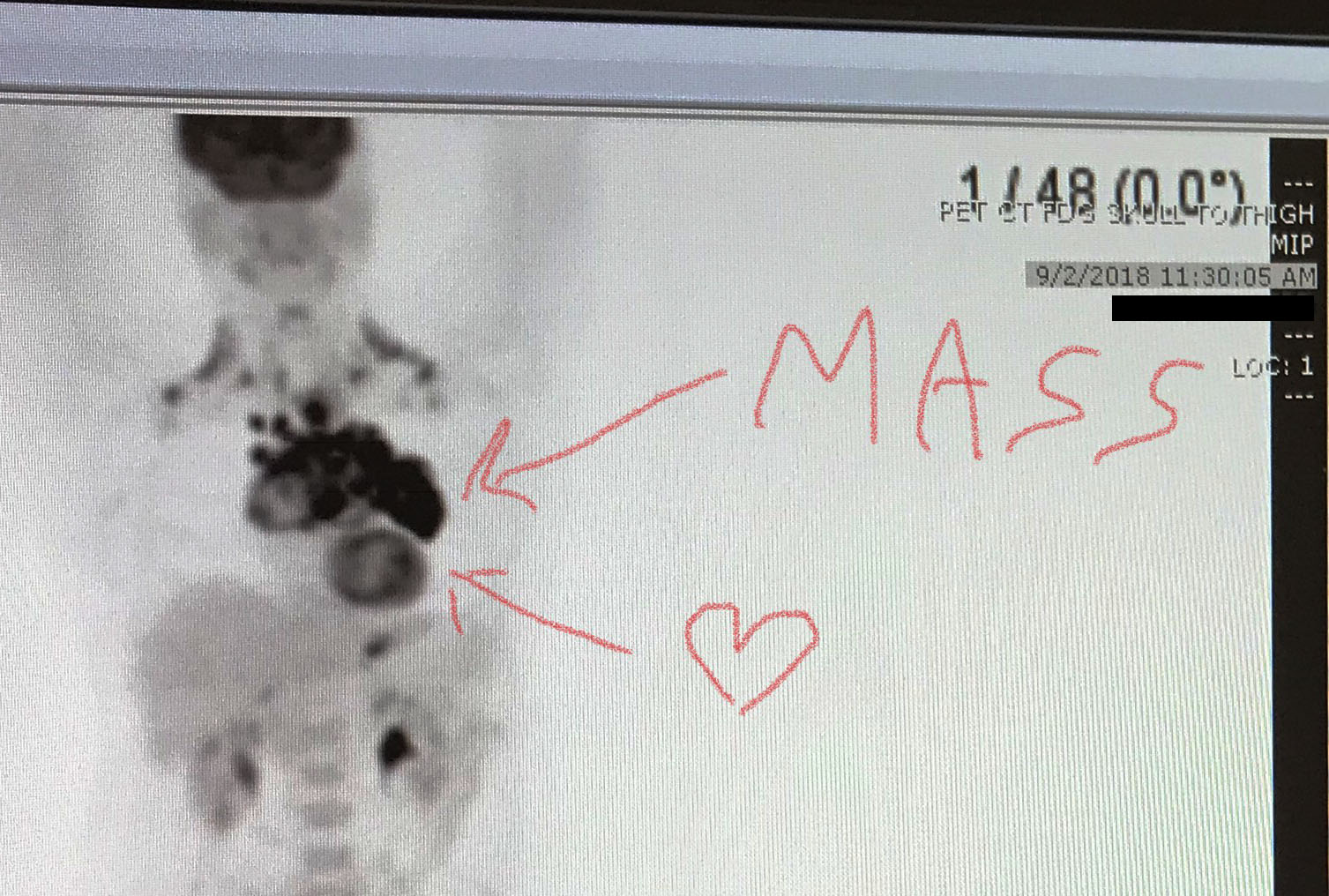 PET scan of lymphoma mass surrounding the patient's heart